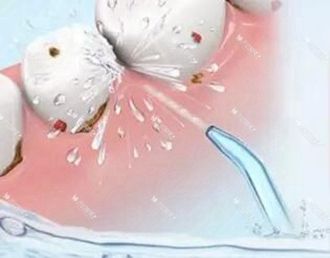 牙齿臭有牙结石怎么去除,牙黄有口臭有牙结石怎么办