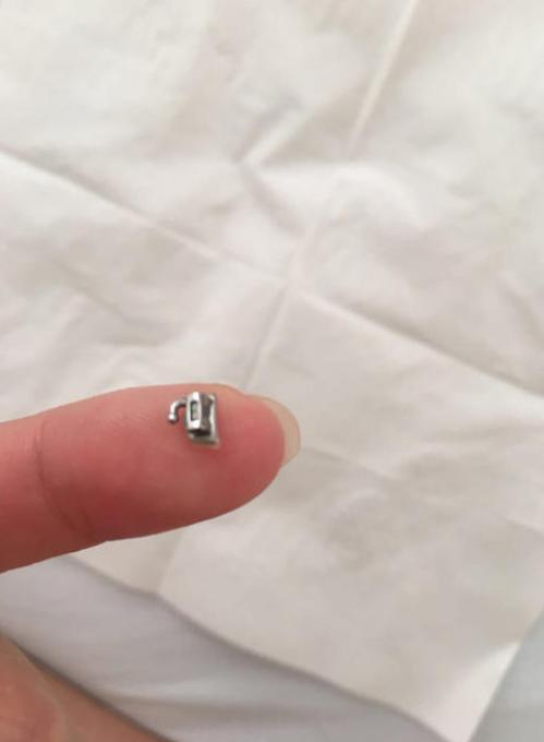 刚刚做完牙齿矫正需要关注什么,牙齿矫正结束后的关注事项