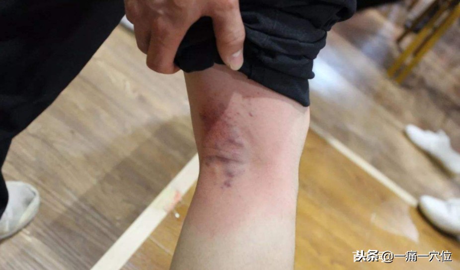 老年足跟痛的治疗方法,老年人足跟痛一招教你解决