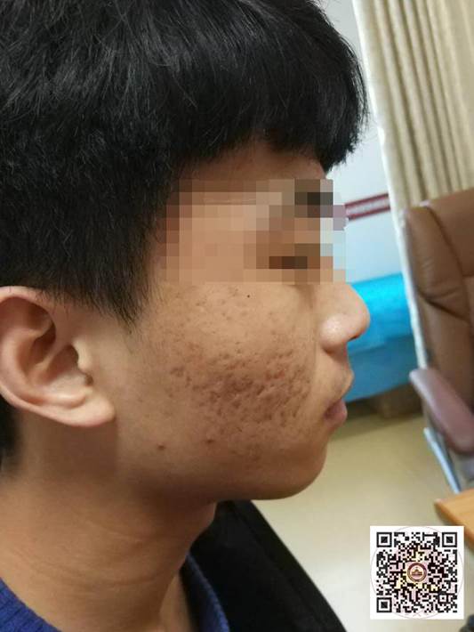 如何去除青春痘的最有效的方法,怎样治疗青春痘最有效的方法