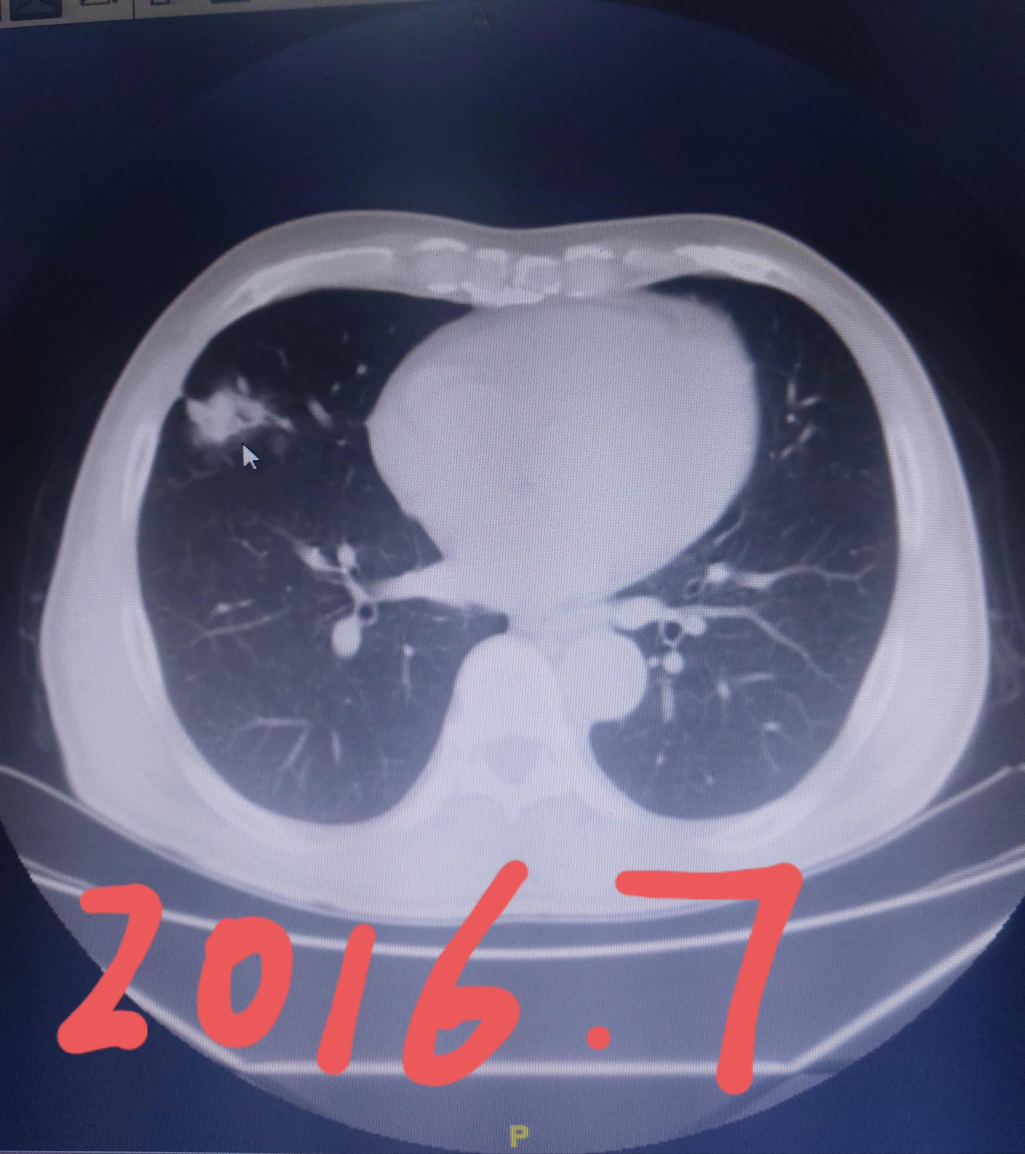 刘懿讲肺结节术前谈话,刘懿博士说小细胞肺癌