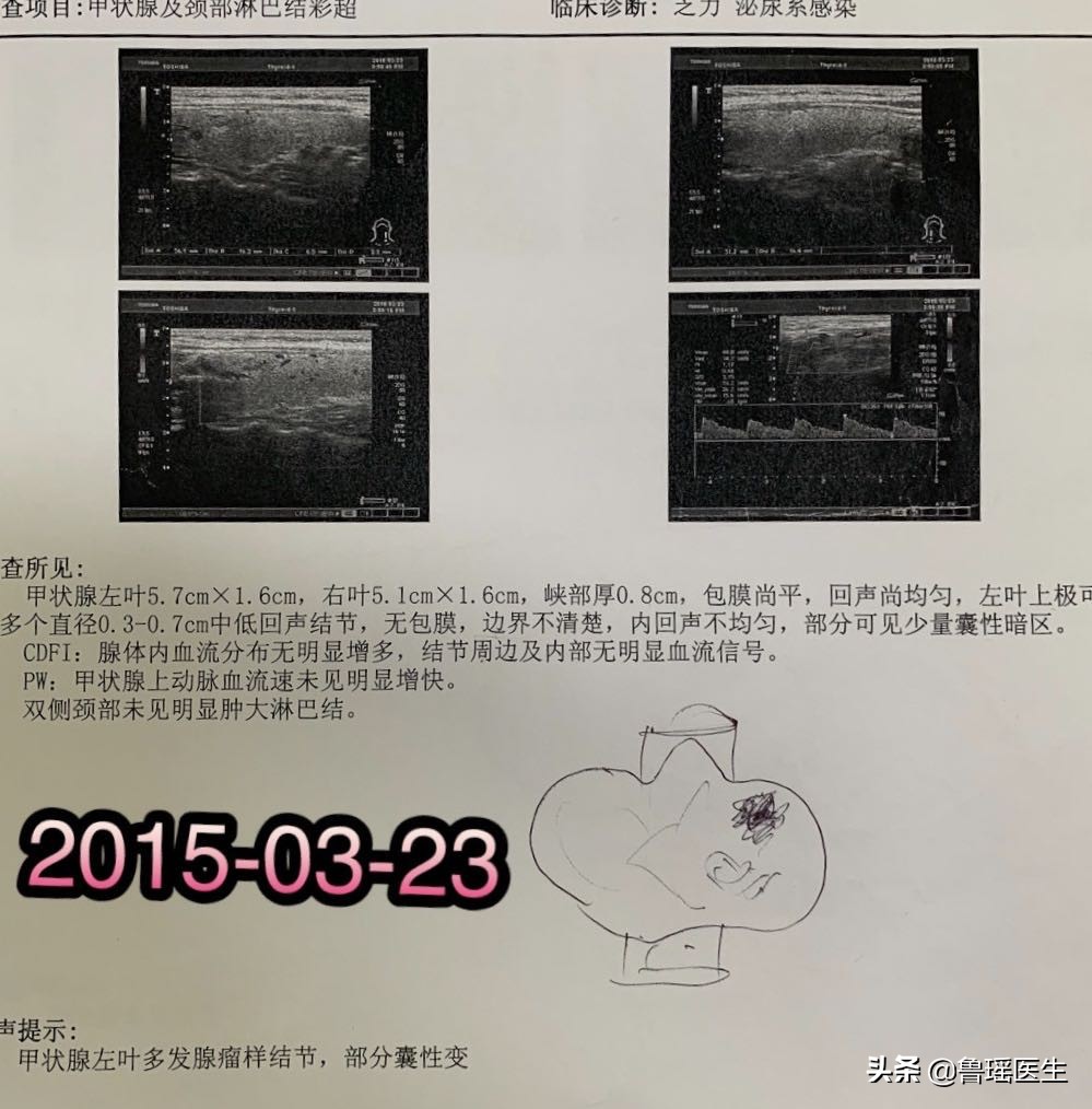 甲状腺穿刺v600e突变是什么意思,b超甲状腺结节误判率