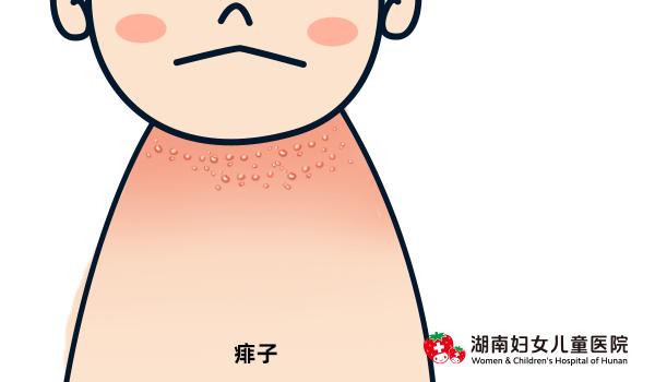 小孩夏天怎么防止痒疹,夏天的宝宝怎么避免热疹