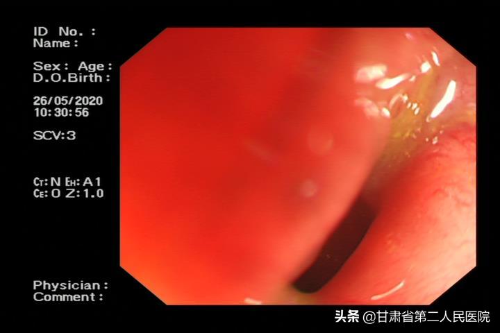 首例！甘肃省二院消化科置入结肠覆膜金属支架治疗术后肠道狭窄