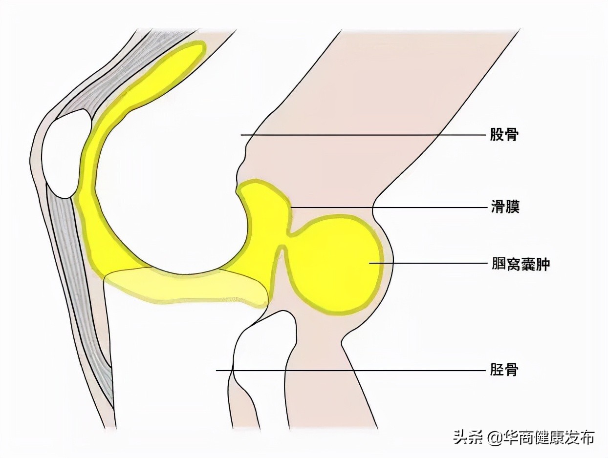 脚膝盖腘窝囊肿手术要关注什么,腘窝囊肿关节镜切除