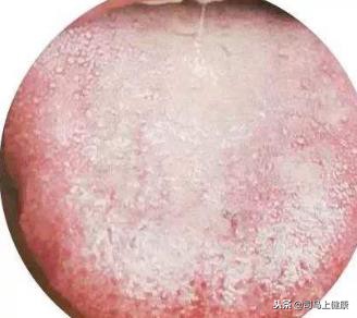 什么是类风湿性关节炎？它有哪些表现？拔罐是怎样治疗的？