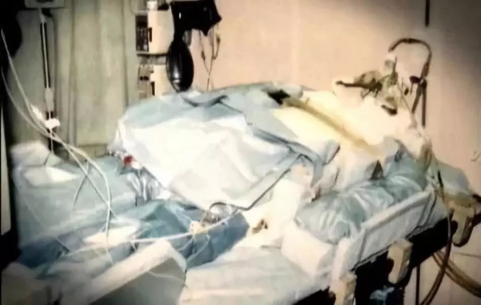 83天痛不欲生的活体腐烂，他在一次核事故后缓慢死去