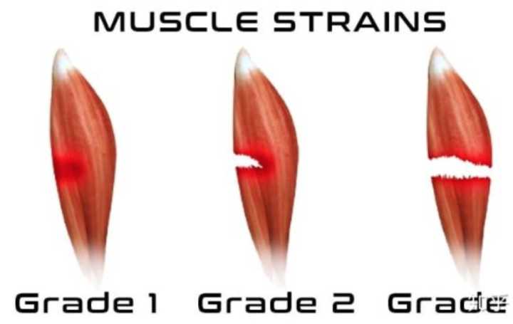 腰肌劳损正确的康复方法是什么,腰肌劳损正确的康复方法