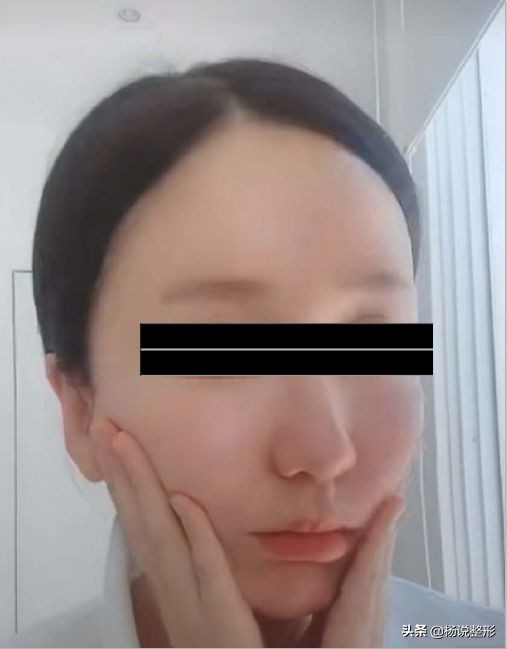 20岁面部凹陷如何改善,脂肪填充面部凹陷怎么导致的呢