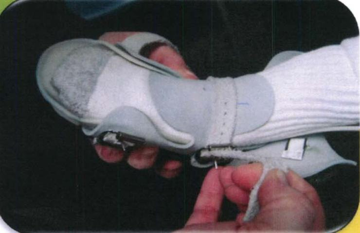 马蹄内翻足的护理有哪些呢,马蹄足内翻矫正支具