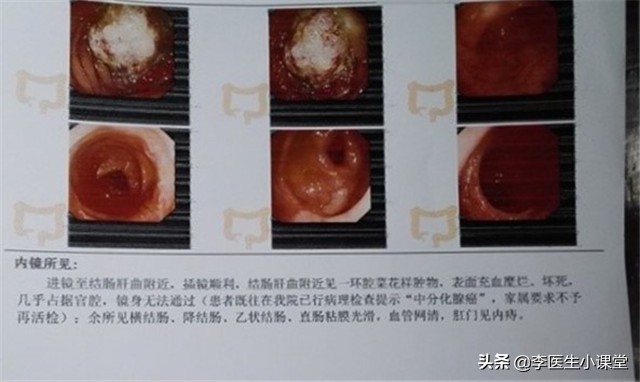 48岁阿姨便血半年，查出晚期肠癌，身体若有这3种情况，及时就医
