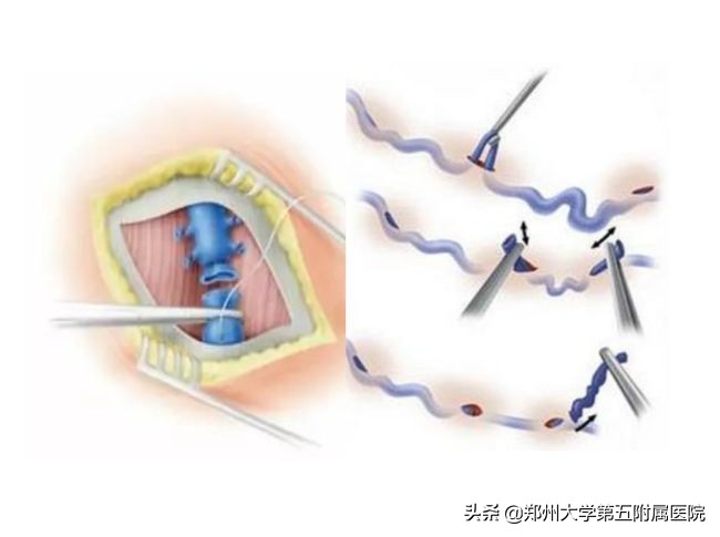 静脉曲张远离老烂腿,下肢静脉血管曲张怎么办