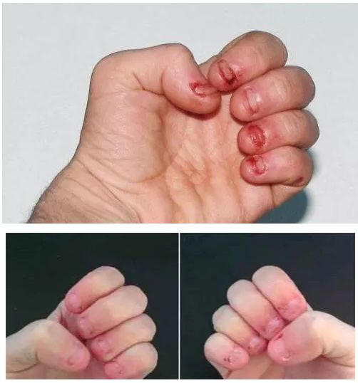 孩子爱啃手指头家长该如何引导,孩子爱啃指甲用什么药改善