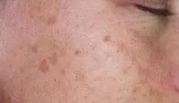 脸部斑的种类及如何辨别,一招教你怎样辨别脸上的斑
