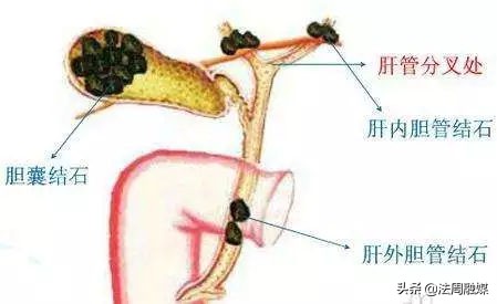 常德：太可怕！每天抢着收拾“残局”六旬老人“引爆”了胆结石