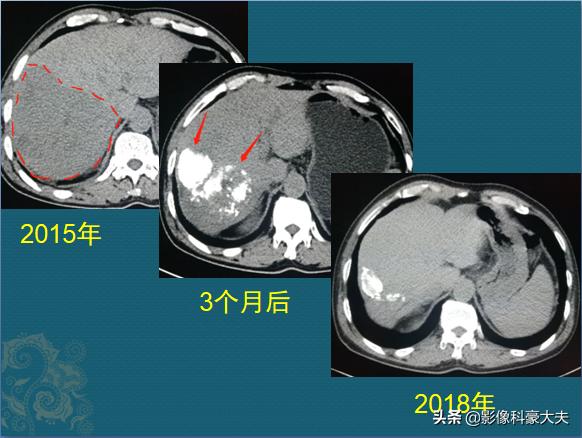 22岁查出癌症放弃治疗,医生自述得癌症放弃治疗