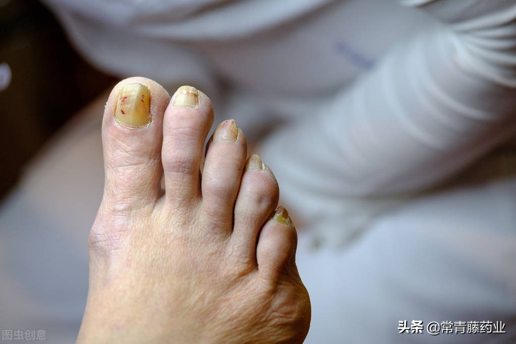 脸上会不会得脚气,脸上有脚气的人