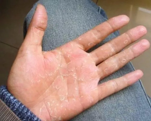 手掌脱皮偏方,手掌脱皮中医怎么治