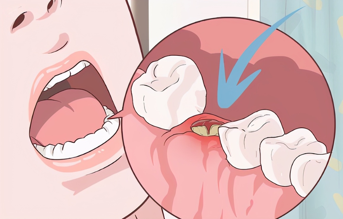 拔牙后怎样能促进牙洞愈合,牙龈伤口一年还没愈合怎么治疗