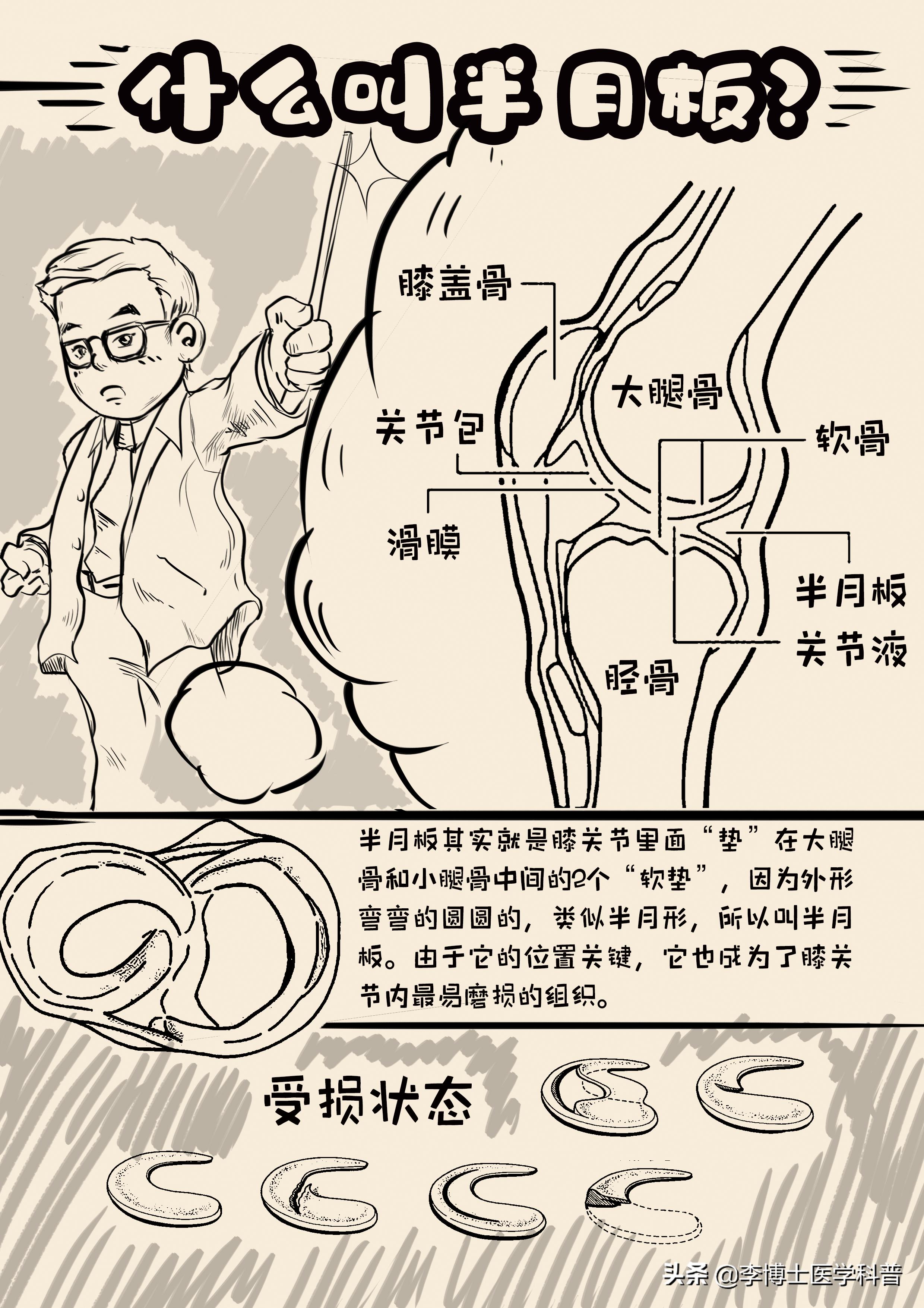 半月板平时关注事项怎样恢复更快,半月板深度科普