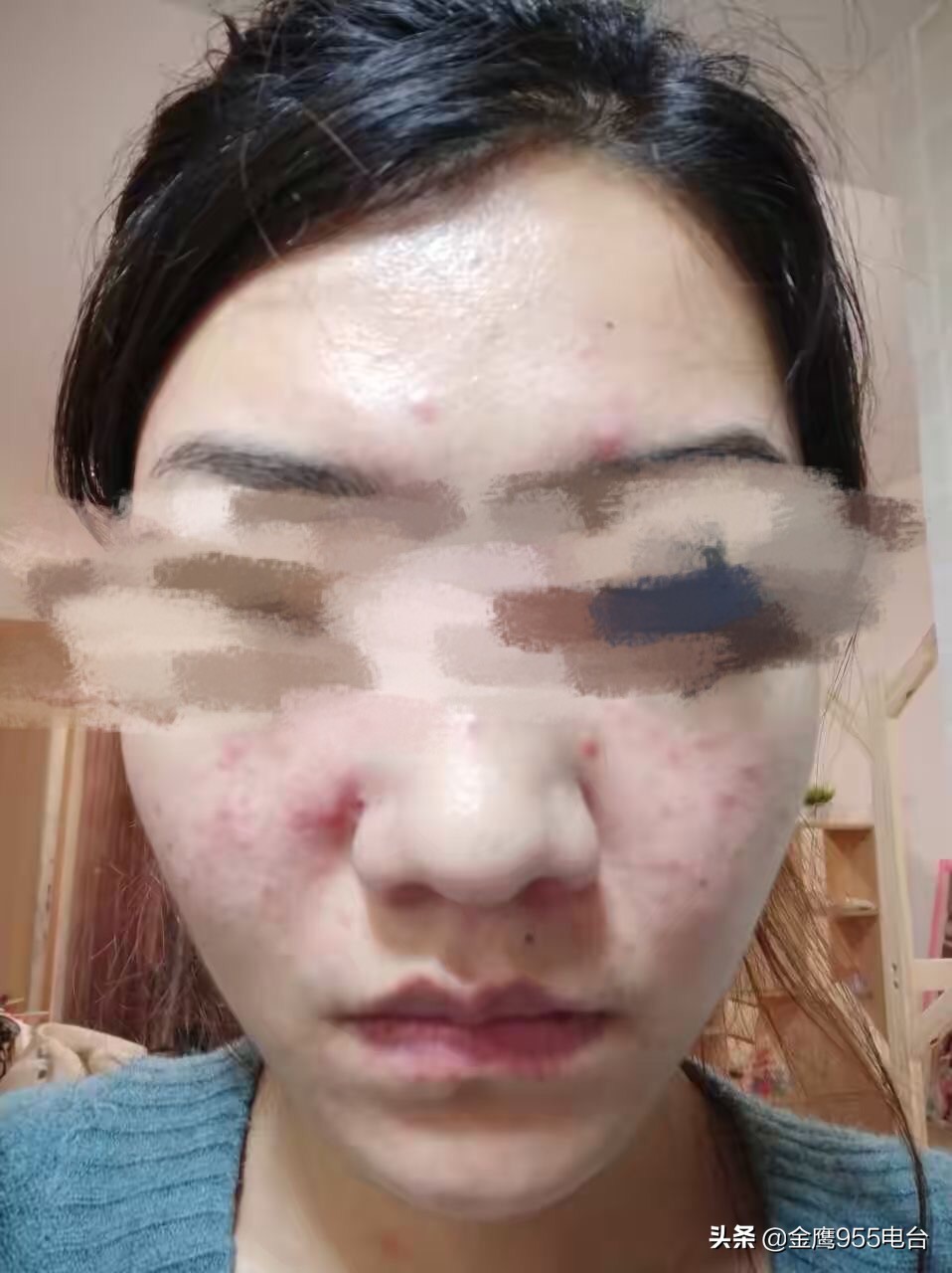 去祛痘险些毁容,祛痘毁容800元