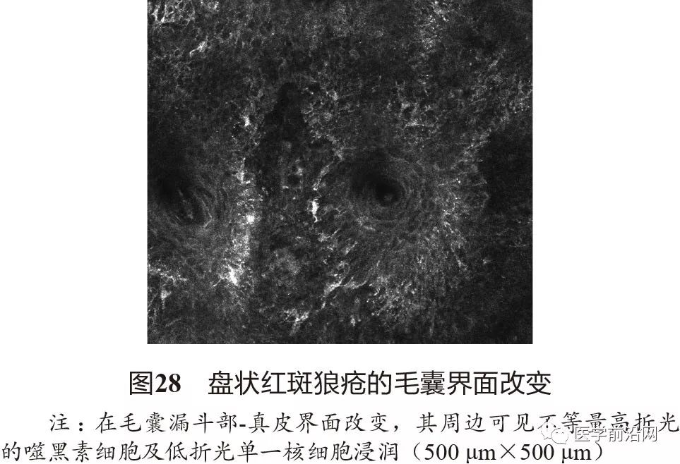 炎症性皮肤病反射式共聚焦显微镜诊断特征专家共识全文发布