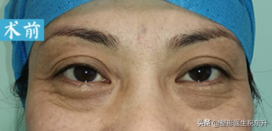 割眼袋和割双眼皮哪个风险大,男士眼袋手术内切有什么风险