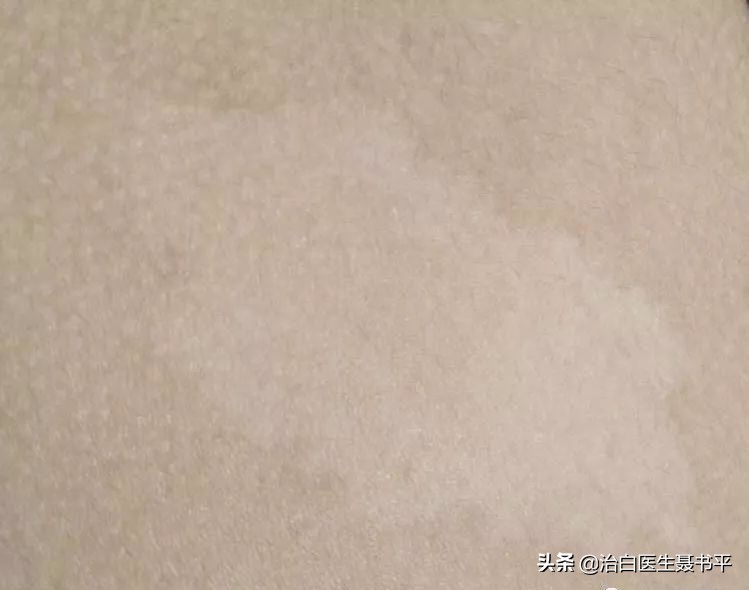 医生无法确定无色素痣还是白癜风,无色素痣误诊白癜风