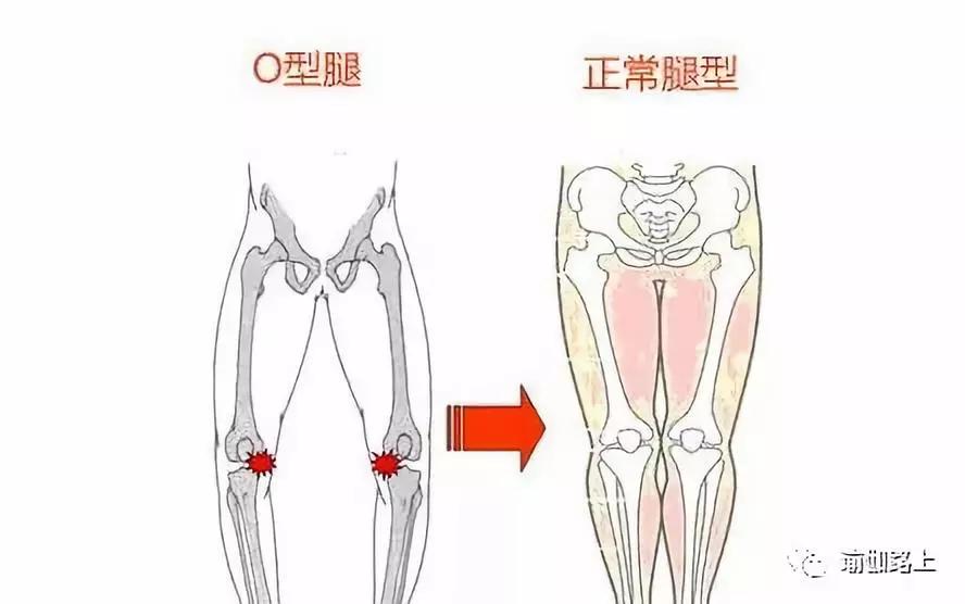 怎样用瑜伽砖矫正xo型腿,瑜伽矫正o型腿
