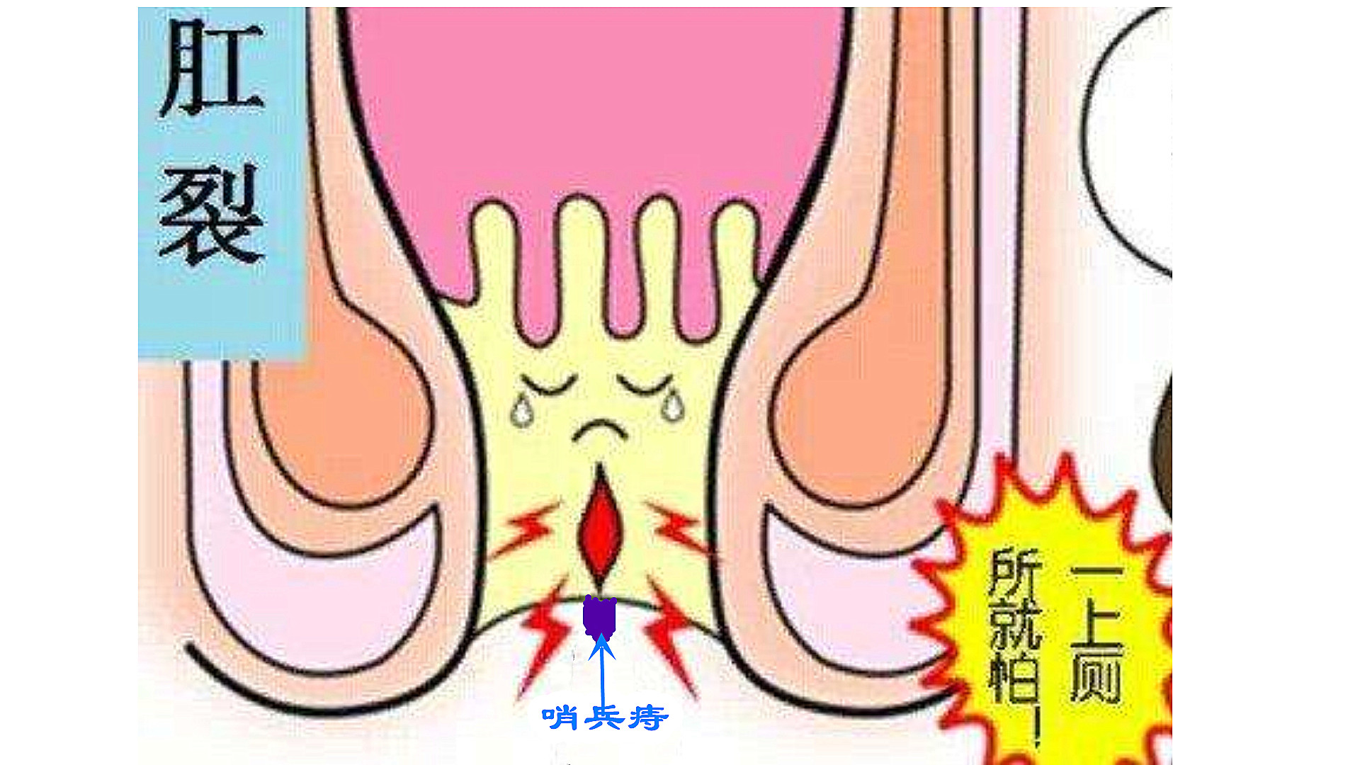 不公平！“痔疮”说：凭什么“肛裂”的锅要由我来背呢