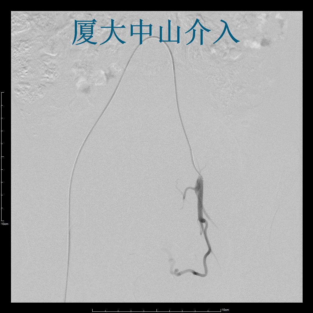 多发巨大的子宫肌瘤做介入栓塞治疗是否有效？