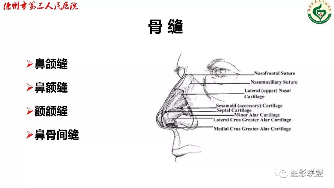 鼻骨骨折dr影像表现,鼻骨骨折影像学诊断