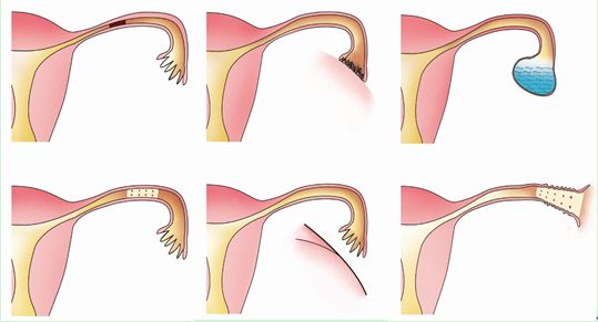 怎么才能确定是输卵管积水,输卵管积水避免加重