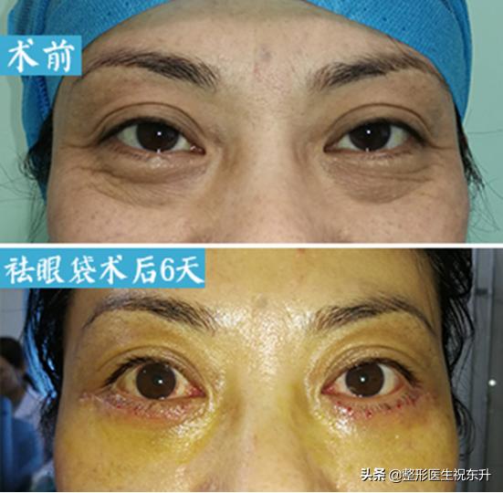 有眼袋、泪沟该怎么办？医生为你支个招