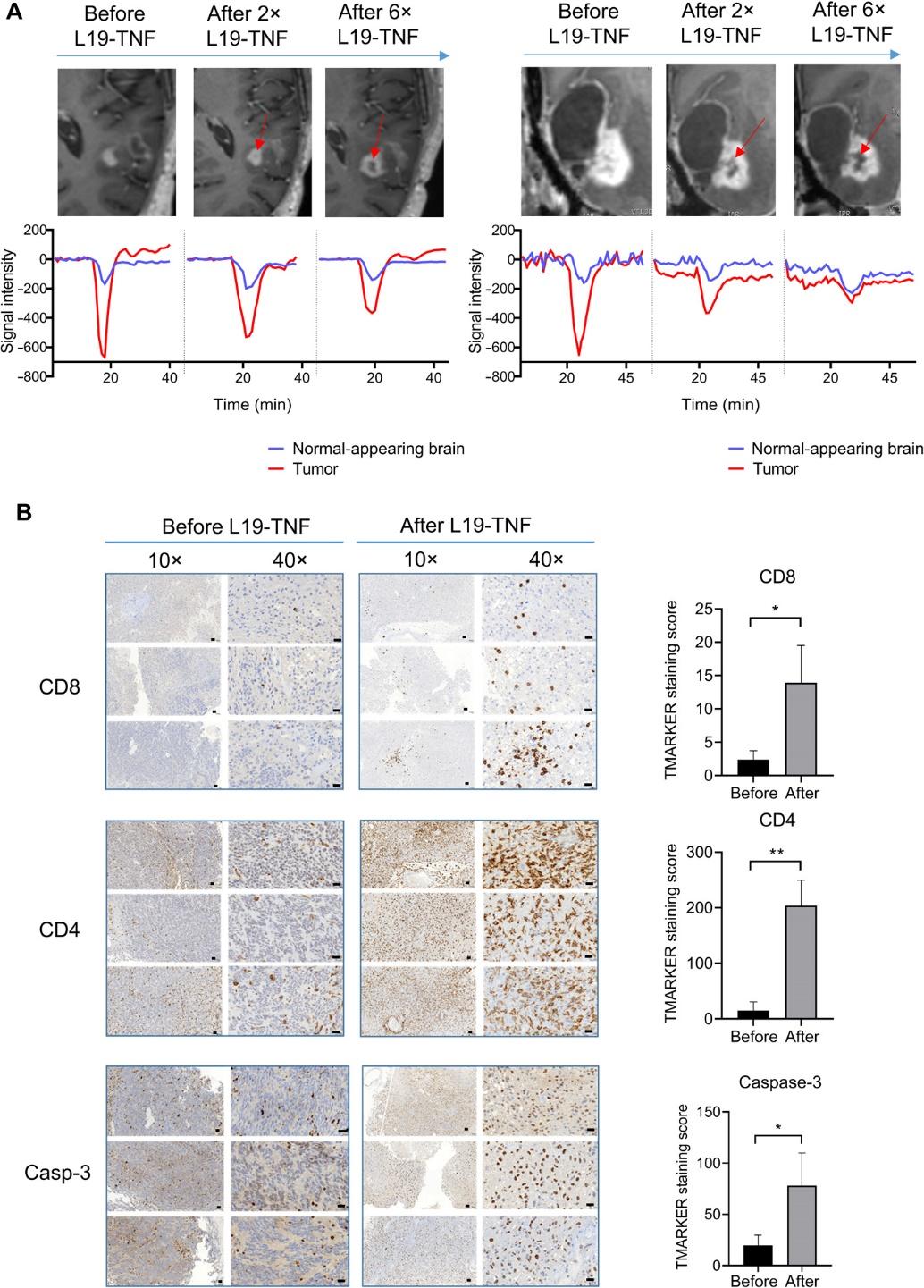 脑肿瘤治疗前沿,脑肿瘤最新研究成果