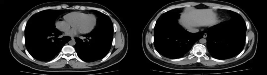 青年男性肺炎过后一直咳嗽怎么办,潜伏结核感染咳嗽咳痰