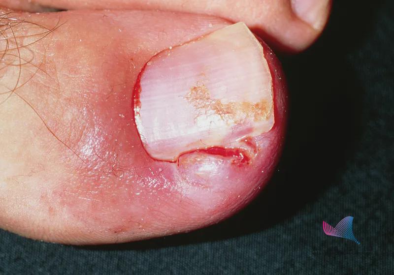 甲沟炎挤出血是什么现象,甲沟炎是剪指甲太深引起的吗