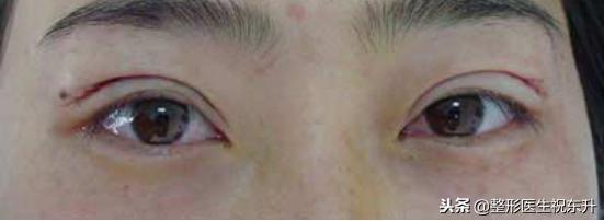 单眼皮与双眼皮的优缺点,欧式双眼皮有什么优缺点