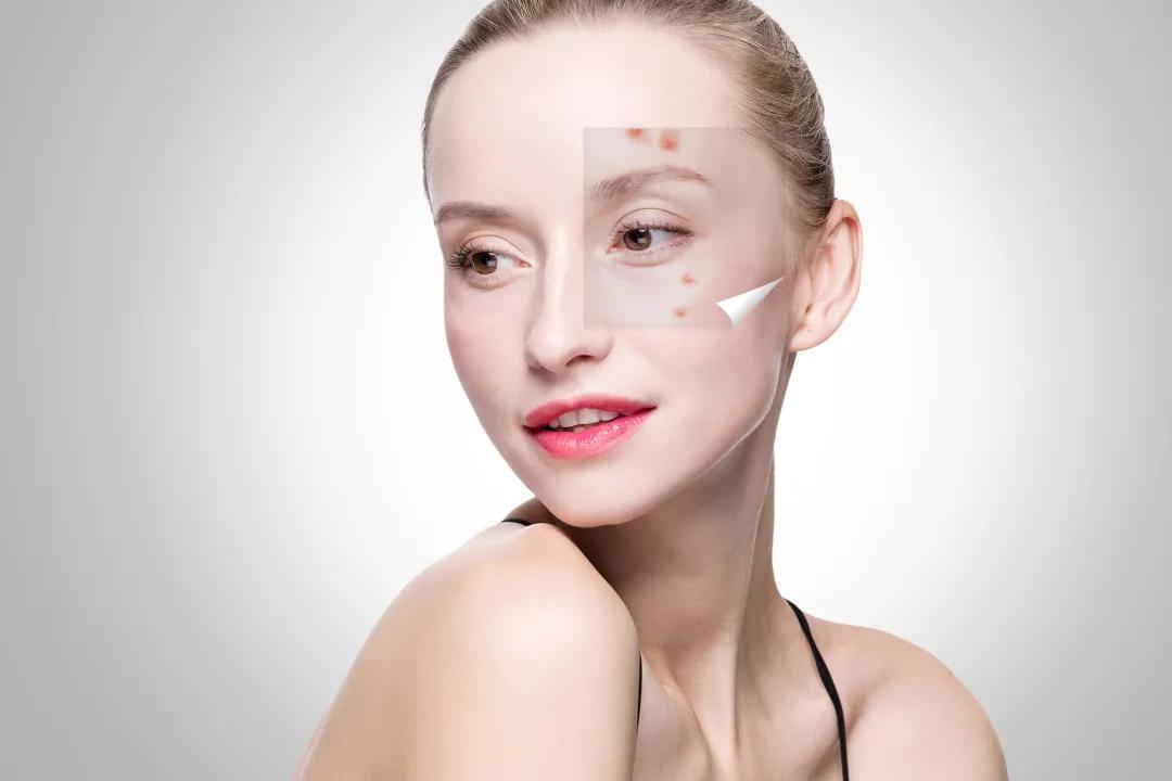敏感肌怎么护肤才能不长痘,脸上抹护肤品容易长痘