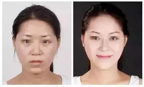 郑州瘦脸针维持时间,瘦脸针后咬肌变化图