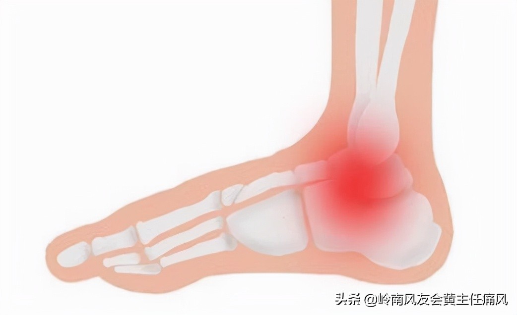 痛风患者做好3件事,做好痛风康复