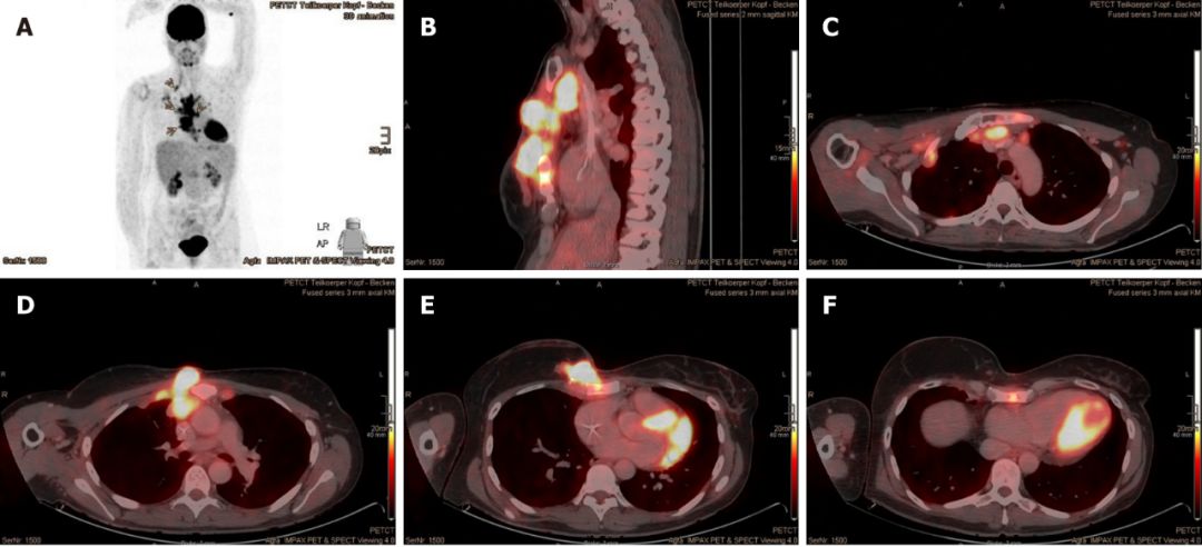 乳腺癌10年,十年乳腺癌患者
