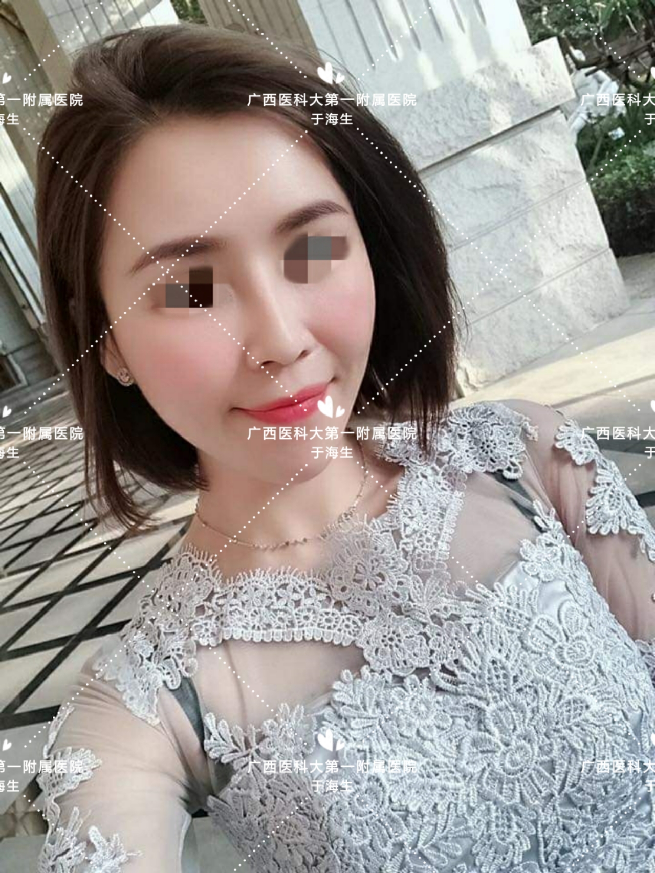 单纯缩鼻翼缩小鼻孔要怎么做,单纯的鼻翼大缩鼻翼有效果吗