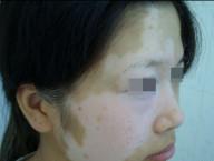 白癜风是怎么引起的怎么去除,白癜风白斑是什么引起的