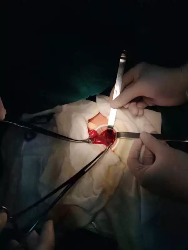 心疼！出生2天早产儿腹胀如包子生命垂危，医生打开腹...