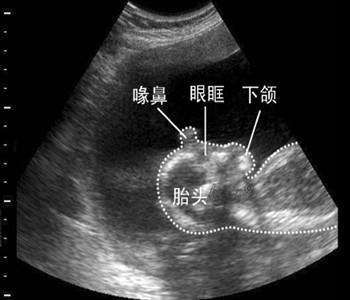 胎儿流掉后医生会怎样处理,自然流出来的胎儿怎么处理