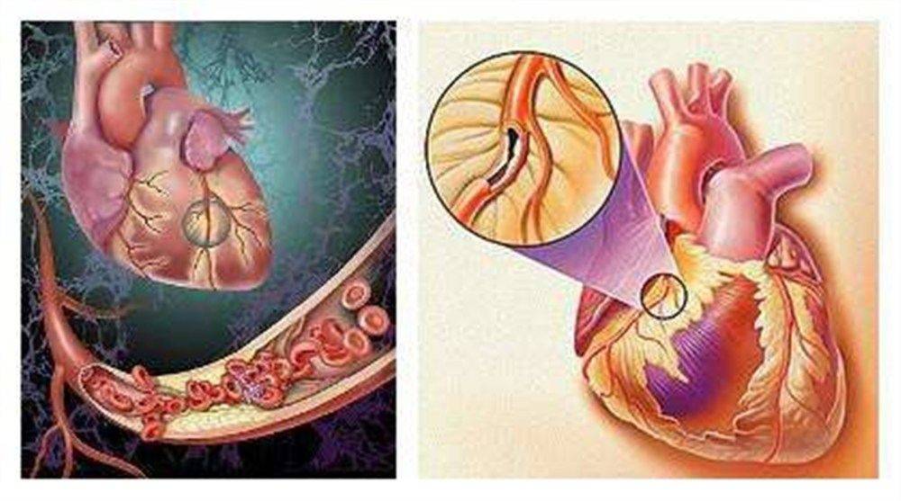 28岁心肌梗塞突然猝死,28岁青年心肌梗死