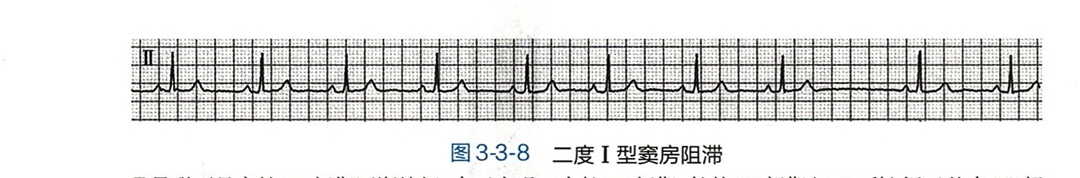 心律失常总结分析,各种房性心动过速心电图解析