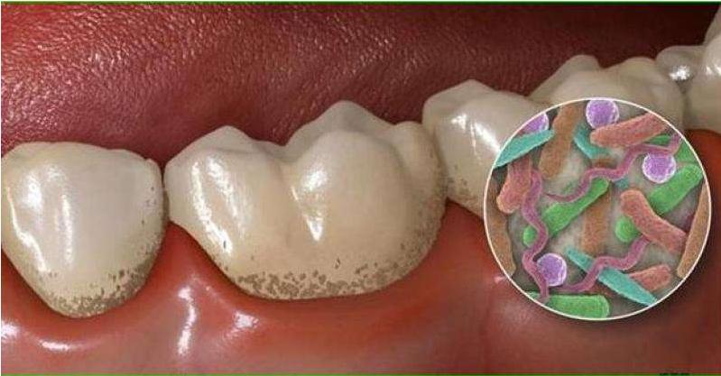 牙釉质受损能自己修复吗,牙釉质损坏有什么补救的吗