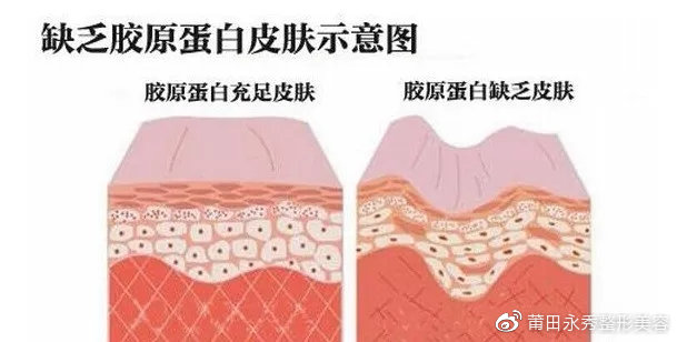 光子嫩肤疼不疼是电流开大了吗,光子嫩肤疼么要敷麻药吗